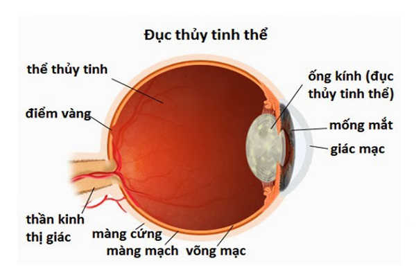 Bệnh về mắt do tiểu đường: Đục thủy tinh thể