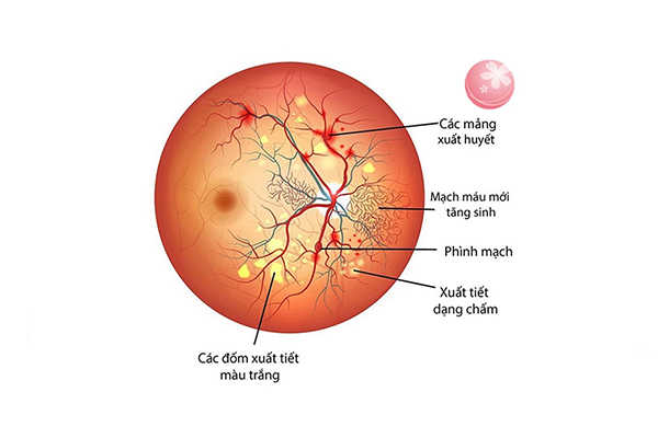 Bệnh về mắt do tiểu đường: Phù hoảng điểm tiểu đường