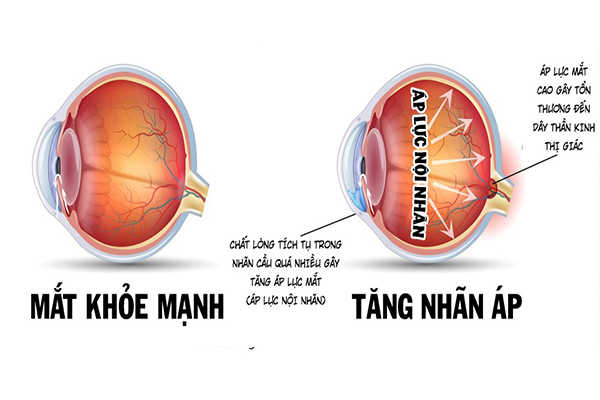 Bệnh về mắt do tiểu đường: tăng nhãn áp