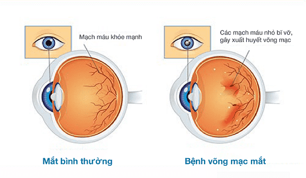 Biến chứng mờ mắt ở bệnh nhân tiểu đường