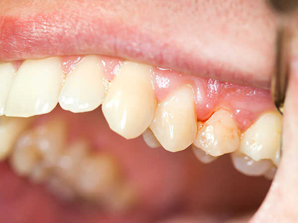 tiểu đường ảnh hưởng như thế nào lên răng