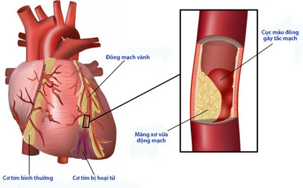 bệnh tim mạch ở bệnh nhân tiểu đường