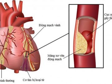 các biến chứng tim mạch do đái tháo đường
